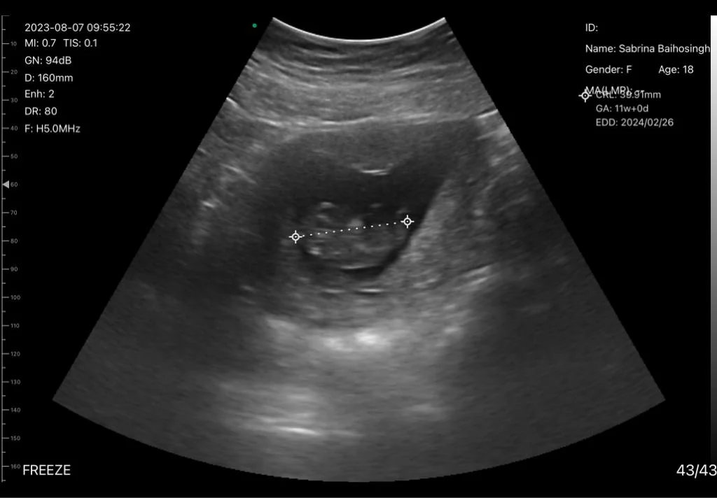 Crown-rump length at 11w+0d on the convex head