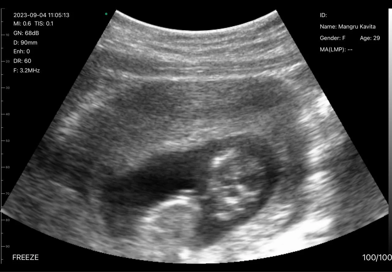 Fetal survey frame from the same session as the 60.73 mm dating scan