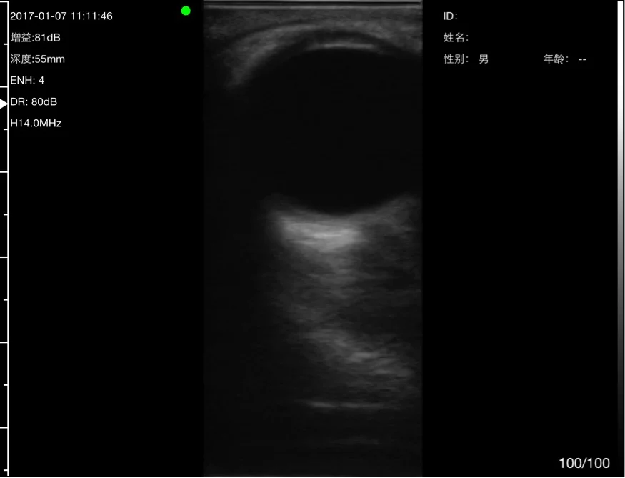 Ophthalmology: ophthalmology 01 ocular b mode still 14 mhz