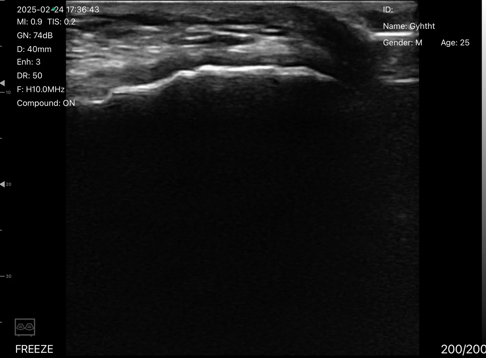 Superficial bone cortex on the D3Ultra