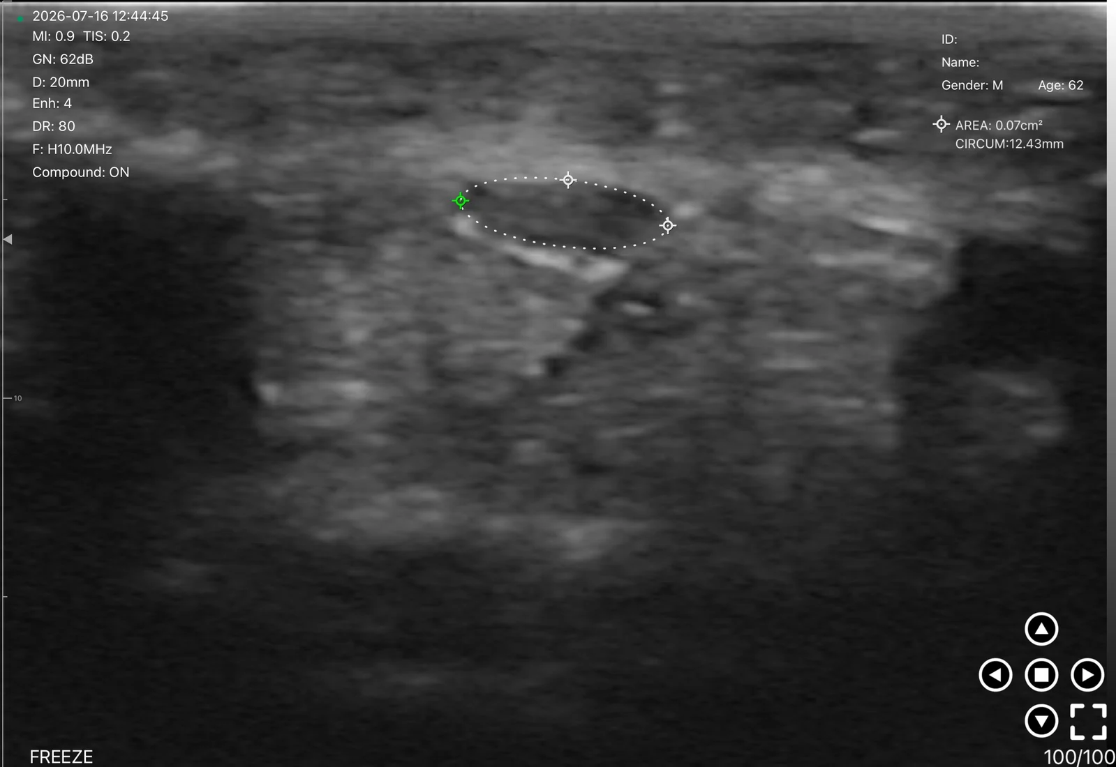 Median nerve area traced at the wrist