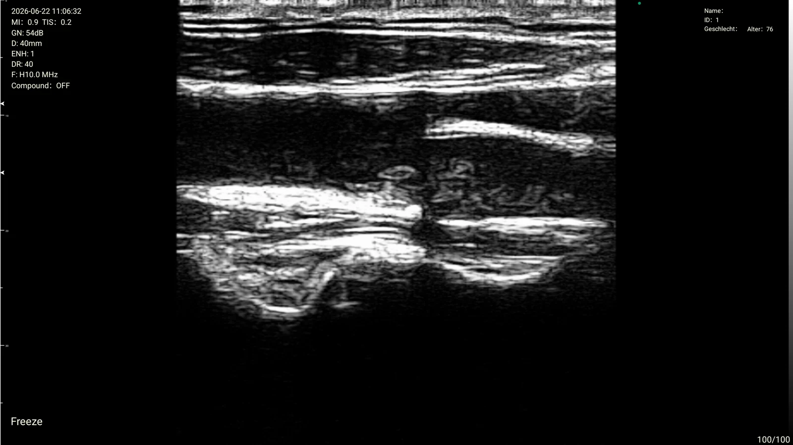 Interscalene brachial plexus on the D3Ultra
