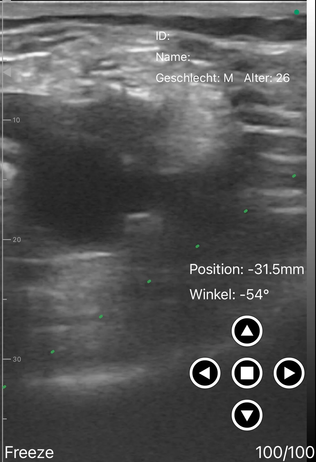 IPACK plane behind the knee
