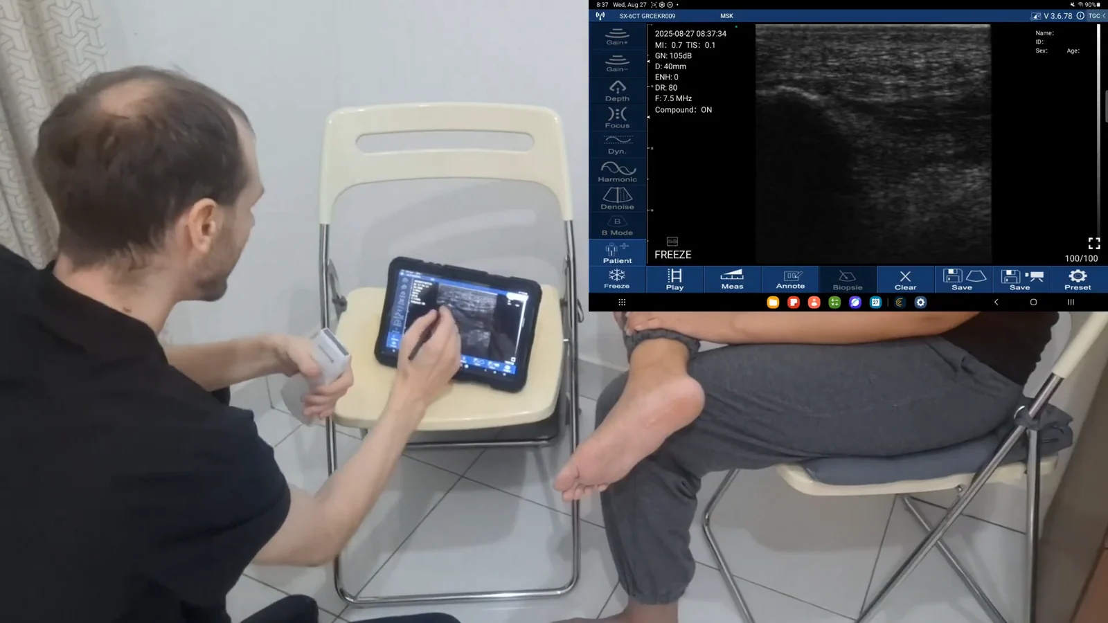 Fascia plantaris bij de oorsprong aan de calcaneus