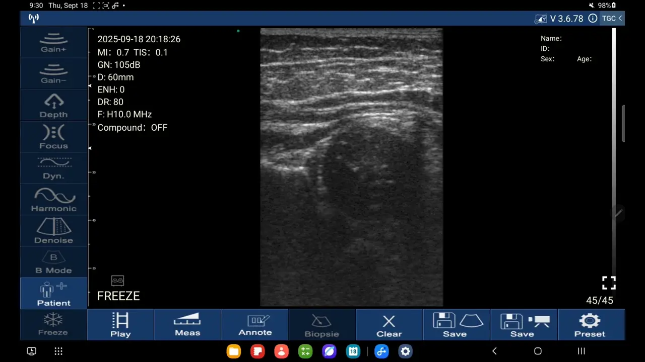 Infant hip POCUS, Graf method