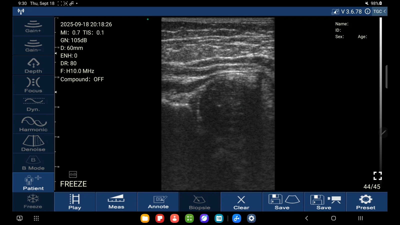 Hold the hip in a true coronal plane