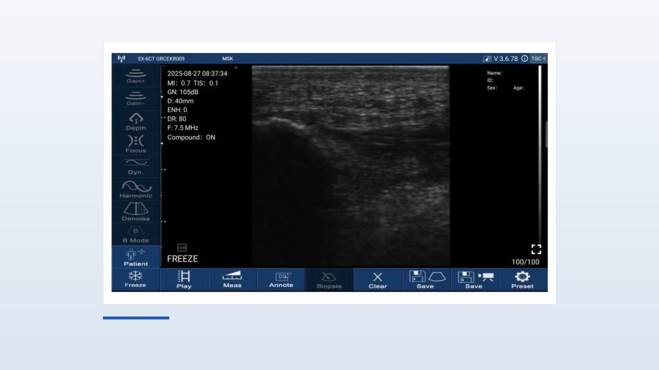 Suresult D3Ultra software window during a plantar fascia scan: the fascia frozen in long axis above the bright calcaneal cortex, MSK preset at 40 mm depth, 7.5 MHz, gain 105 dB