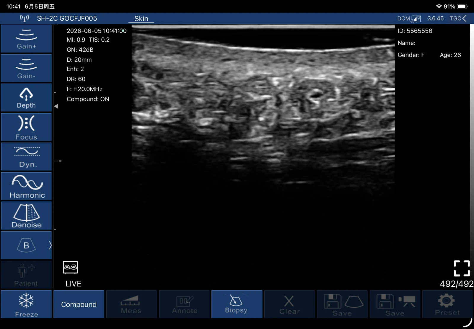 Plastic Surgery: plastic surgery 02 subcutaneous fat lobules septae 20 mhz
