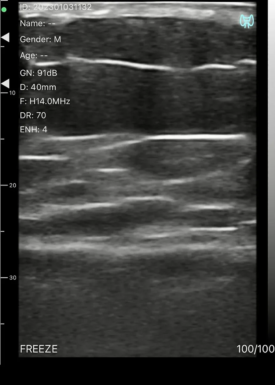 Layered facial soft tissue on the L14