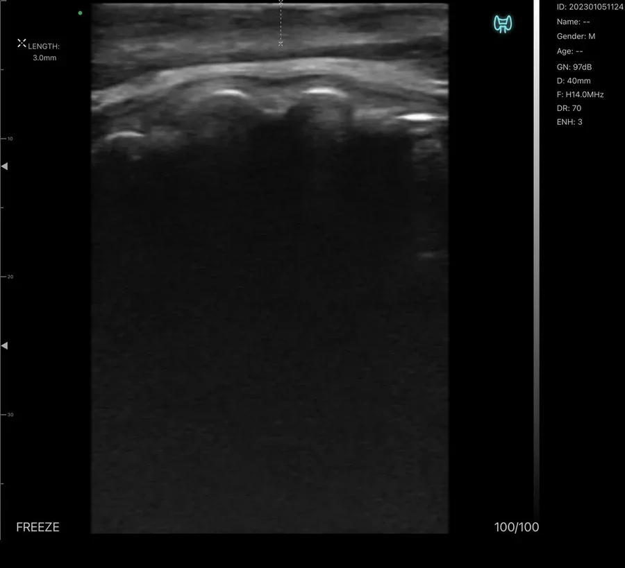 Nasal framework measured at 14 MHz