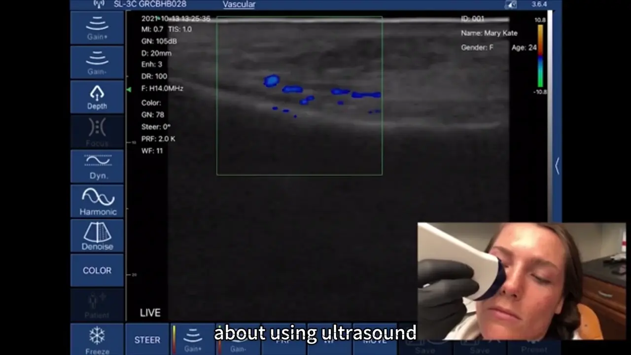 Facial vein mapping on the L20 and L14
