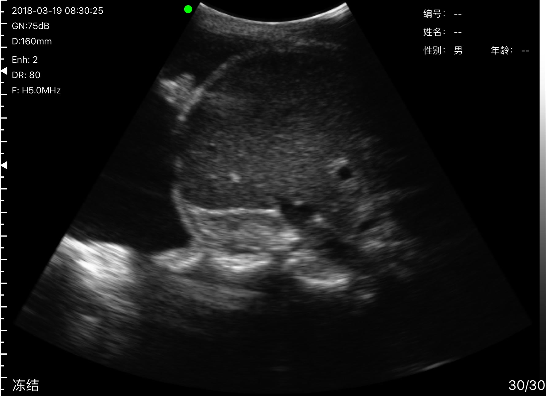 Pleuravocht op echografie: donker vocht opent een venster boven het heldere gebogen diafragma met daaronder een solide orgaan, harmonische beeldvorming op 5 MHz bij een diepte van 160 mm, gain 75 dB