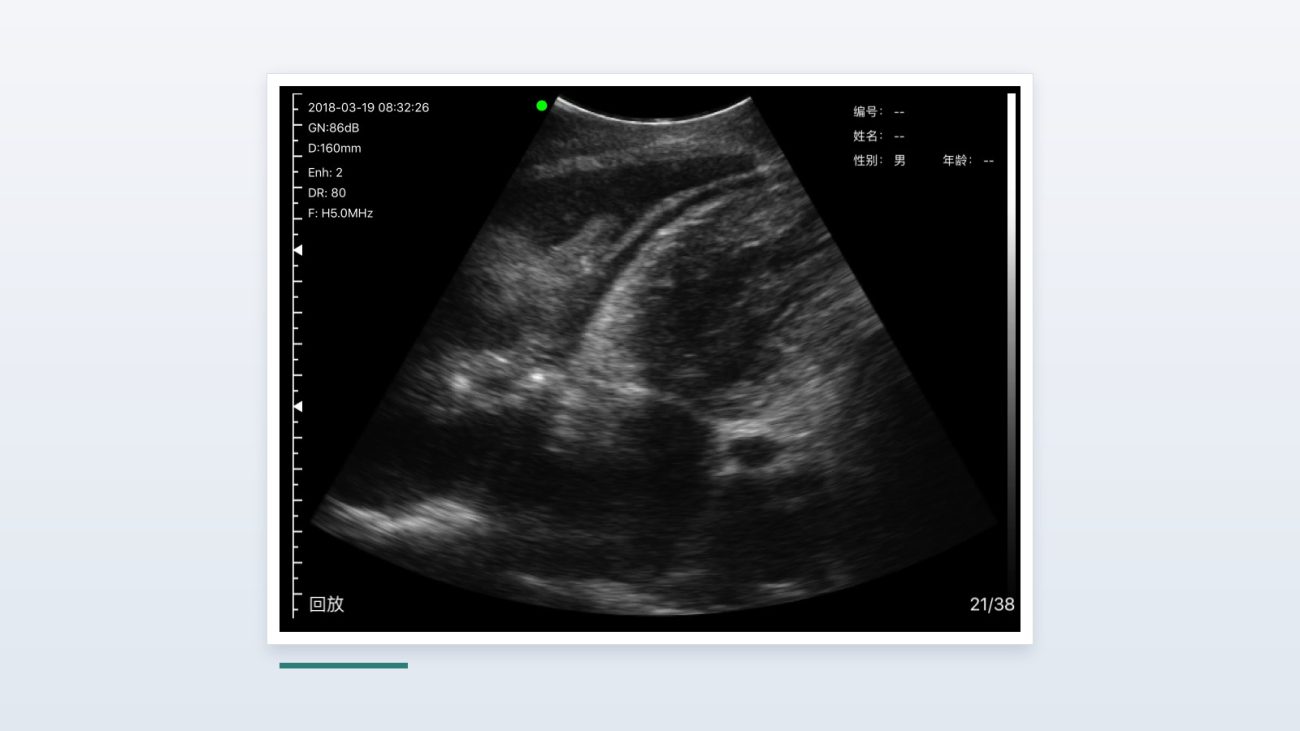 Pleural effusion on a Suresult handheld convex probe: collapsed lung drifting inside the fluid above the bright curve of the diaphragm, 160 mm depth at 5 MHz harmonic, gain 86 dB