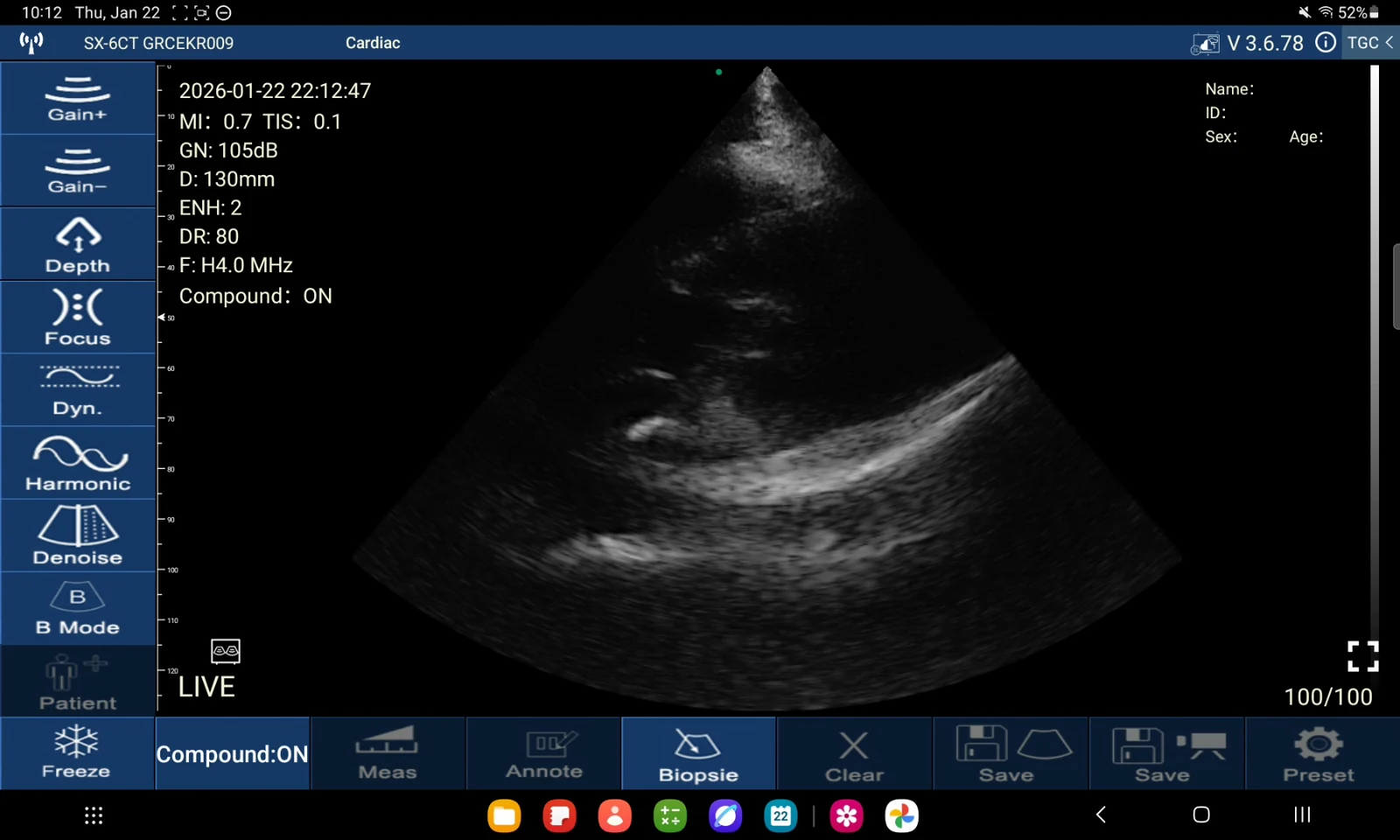 Suresult D3Ultra parasternal long-axis cardiac scan at 4.0 MHz and 130 mm depth, full app interface