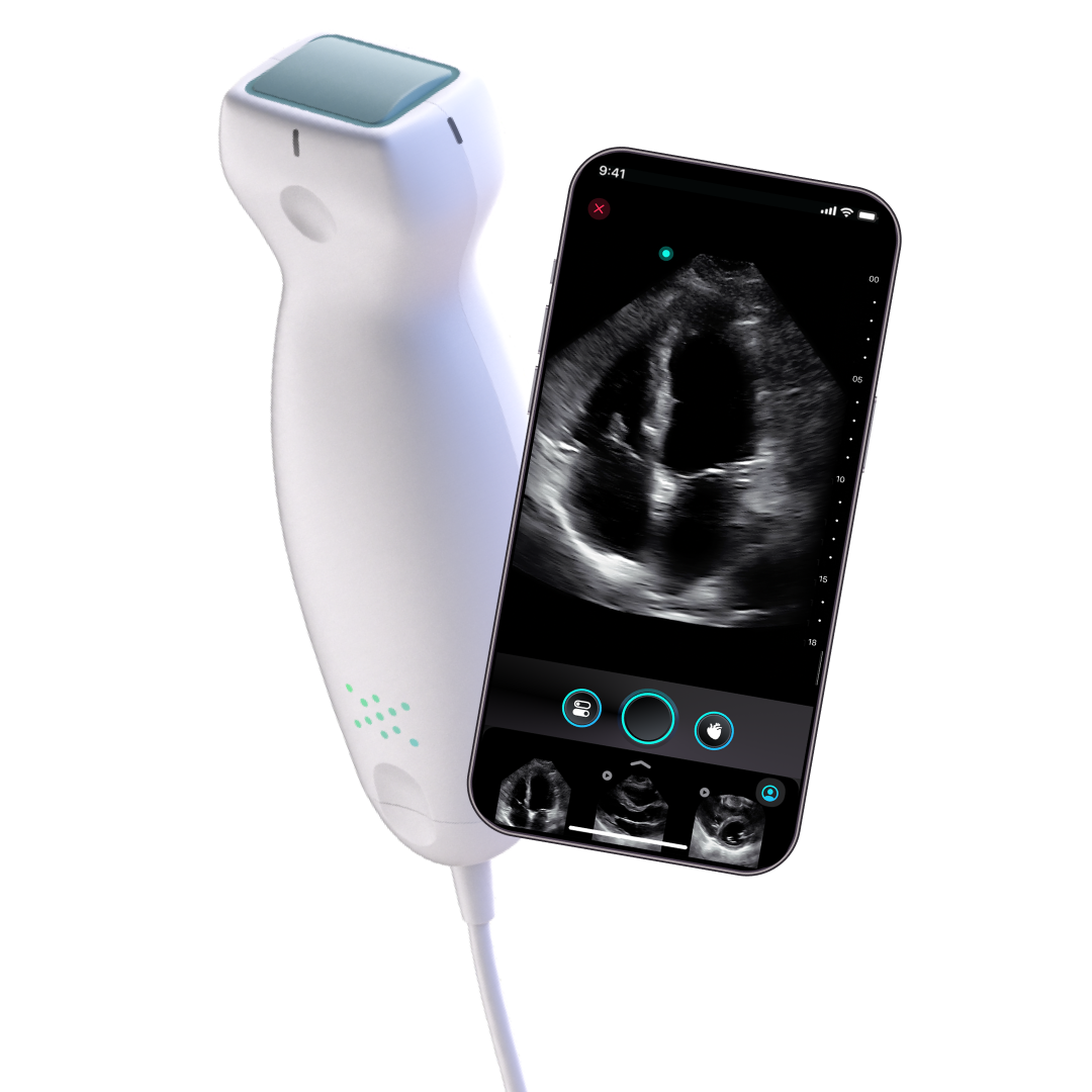 Exo Iris handheld ultrasound connected to an iPhone displaying a cardiac ultrasound image