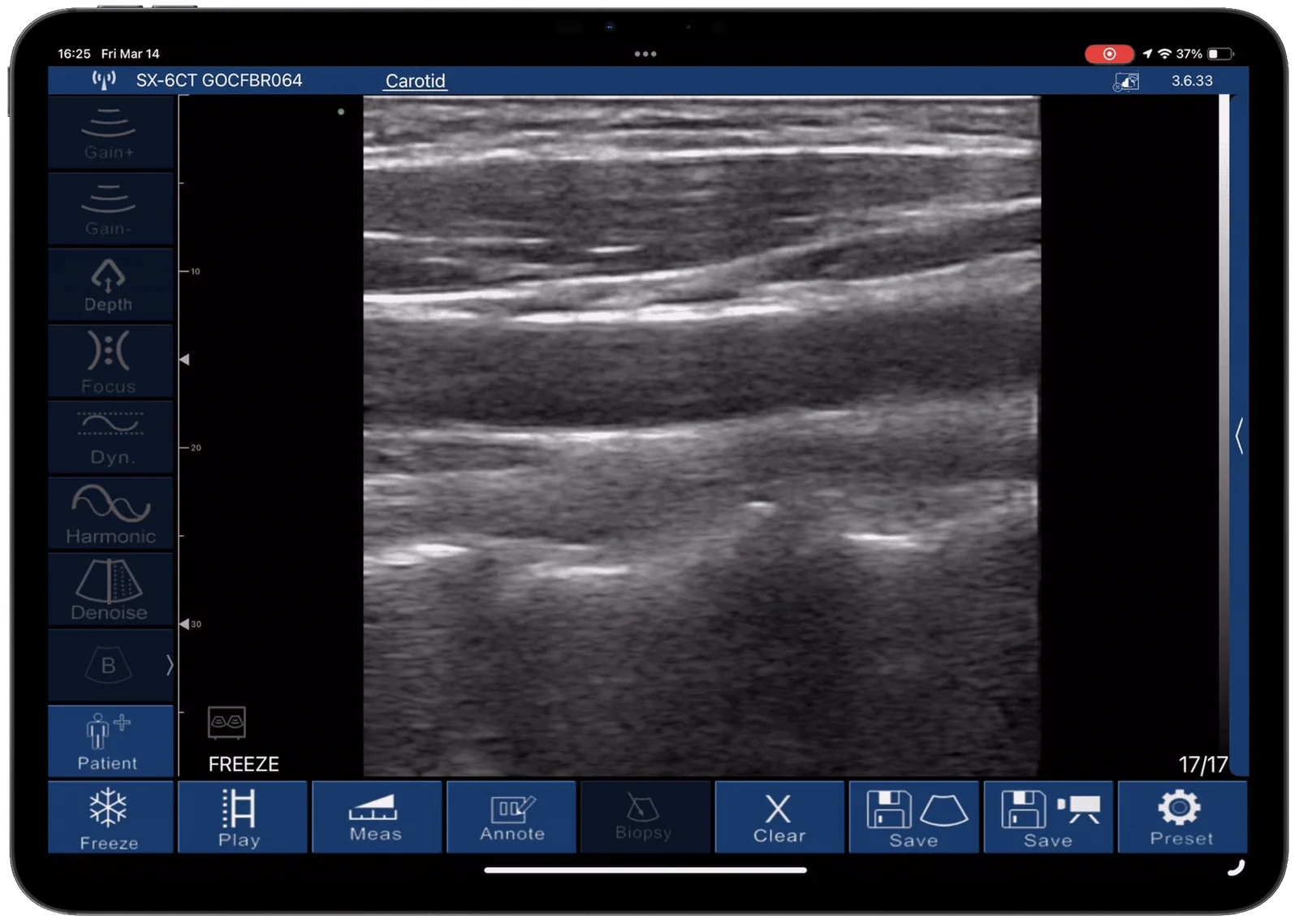 Measure on screen while the patient is there.