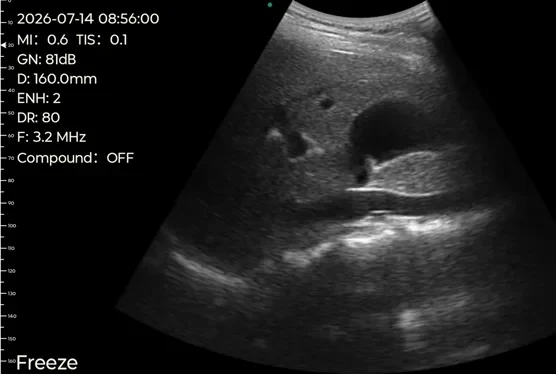 Deep convex gallbladder scan on a handheld ultrasound