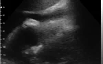 psa cd2 cardiac