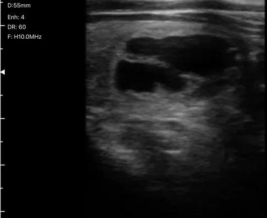 Thyroid lobe ultrasound image from a high-frequency linear probe