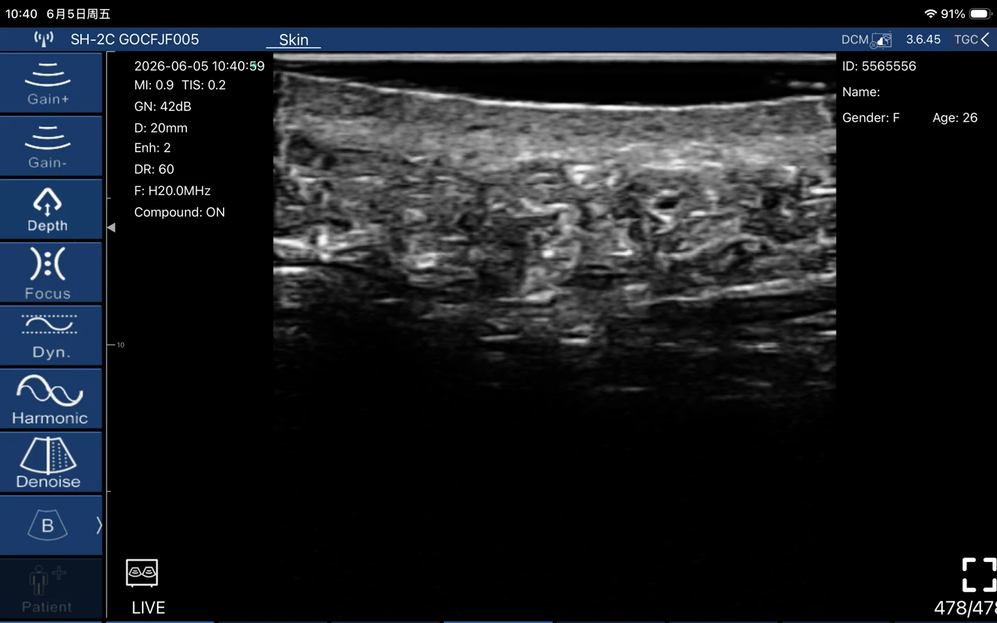 A 20 MHz linear scan separating epidermis, dermis and subcutaneous tissue as distinct layers