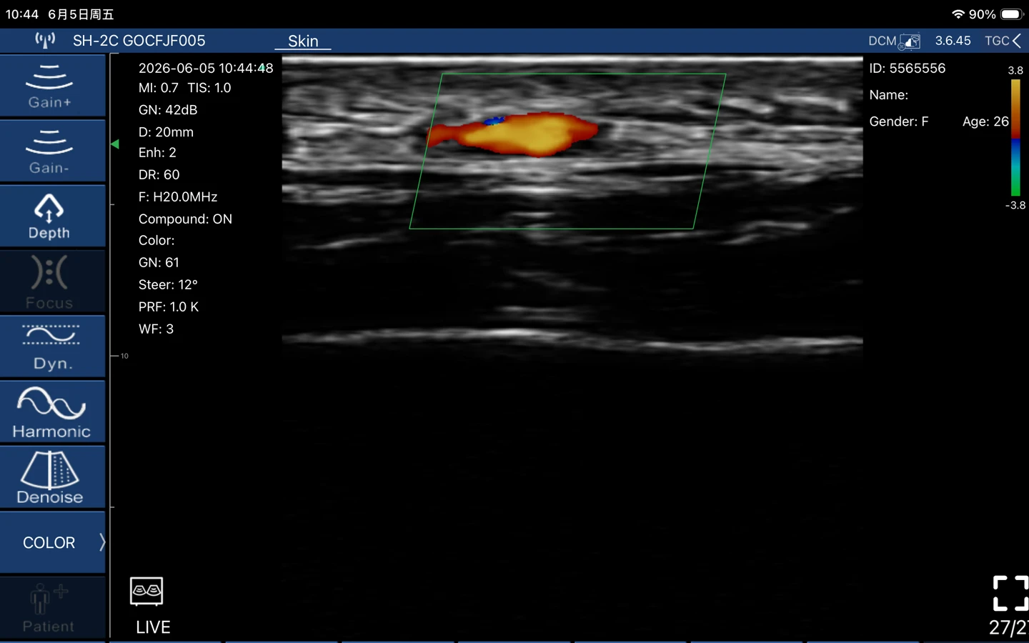 Color Doppler on a high-frequency linear scan showing a subcutaneous vessel in the skin layers
