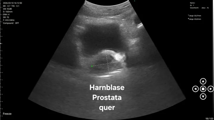 Labelled bladder ultrasound still with volume measurement callouts