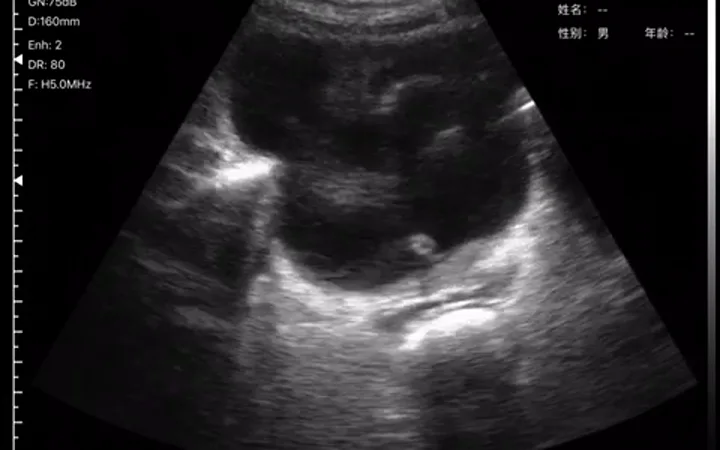 Fan-view bladder ultrasound frame from a volume exam