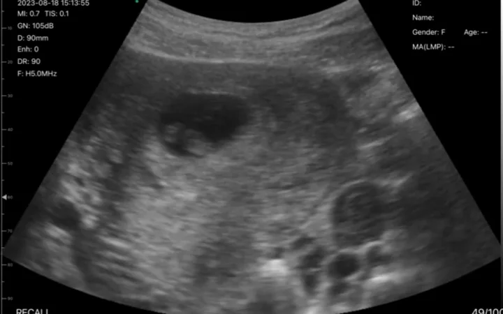 Early-pregnancy convex ultrasound view with CRL measurement