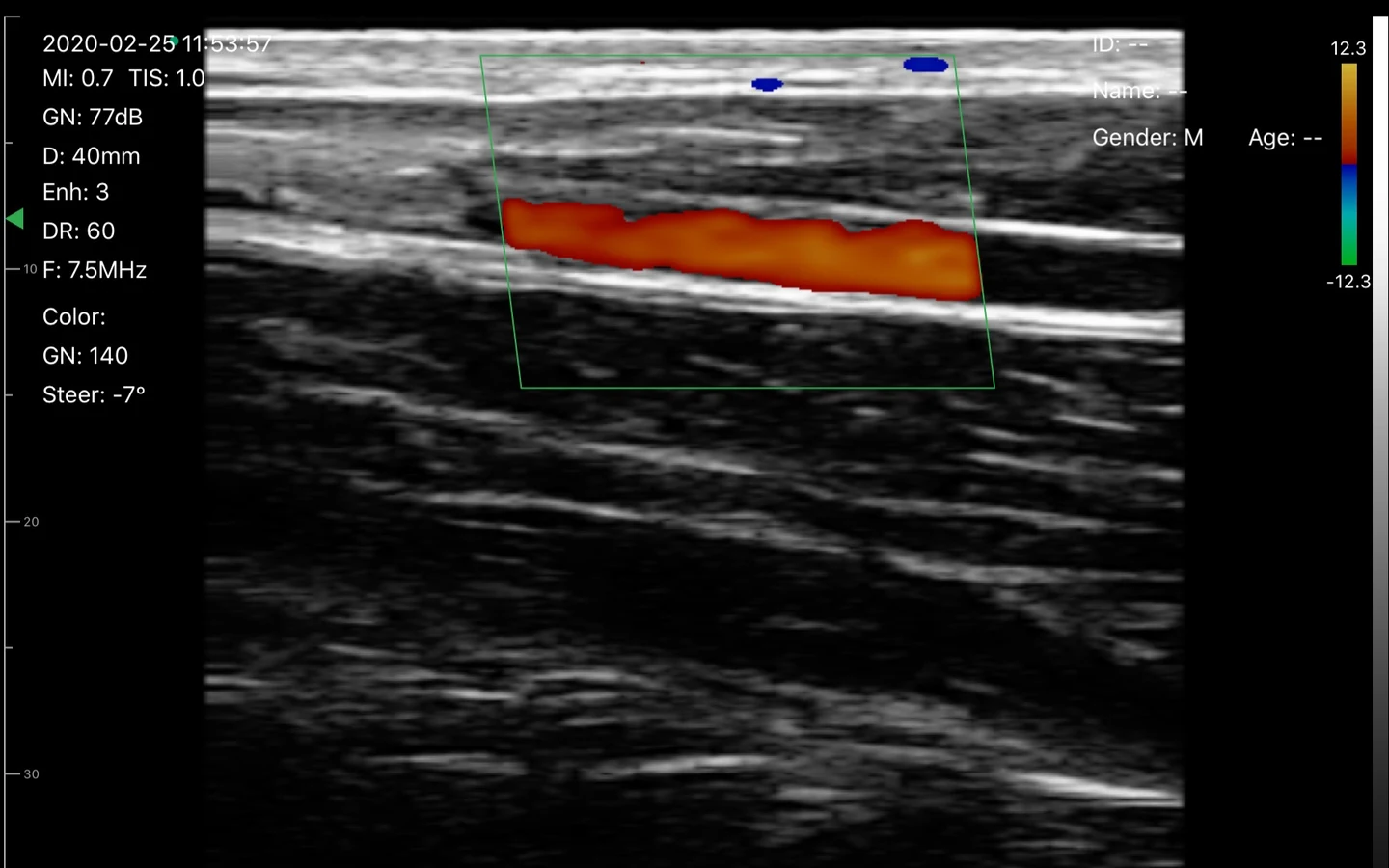 Forearm vessel filled with Color Doppler on a 7.5 MHz linear scan
