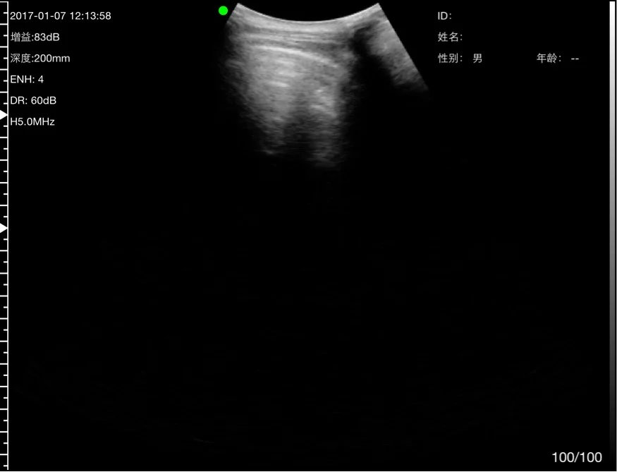 The pleural line, the reference for every lung window