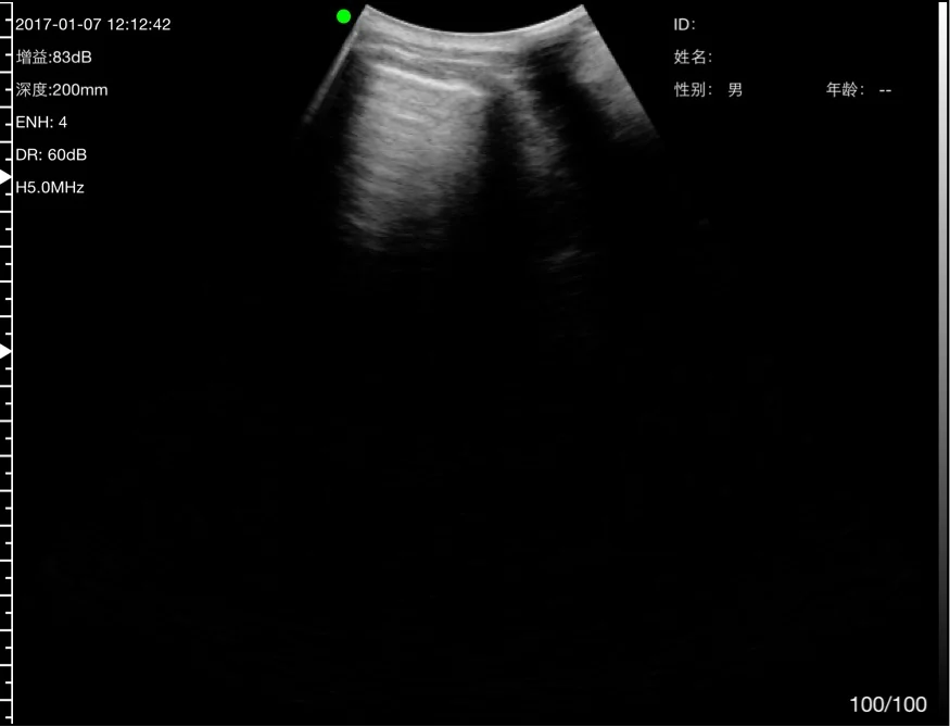 Two rib shadows framing the pleural window