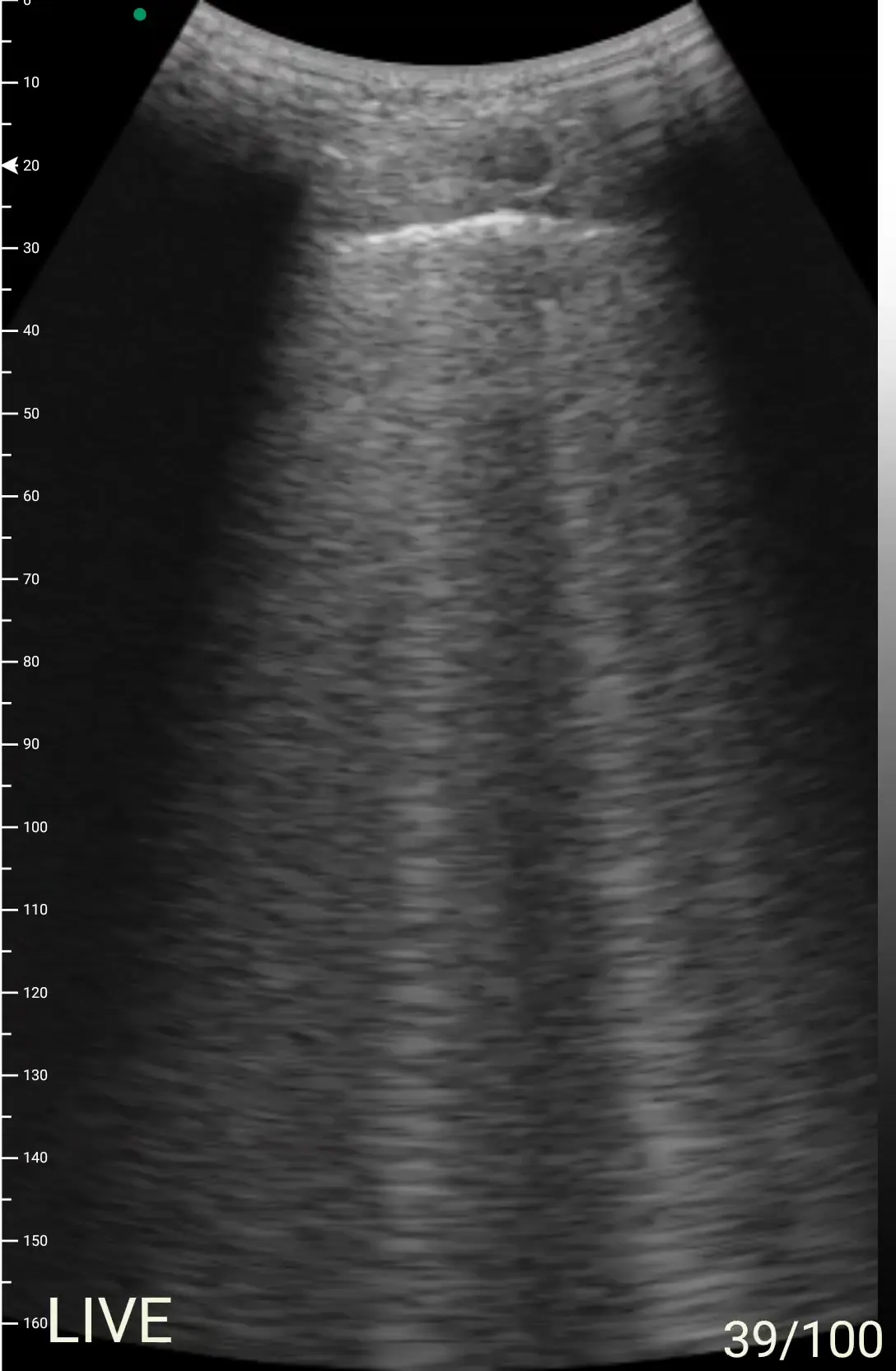 Diffuse B-lines in acute pulmonary edema on the D3Ultra