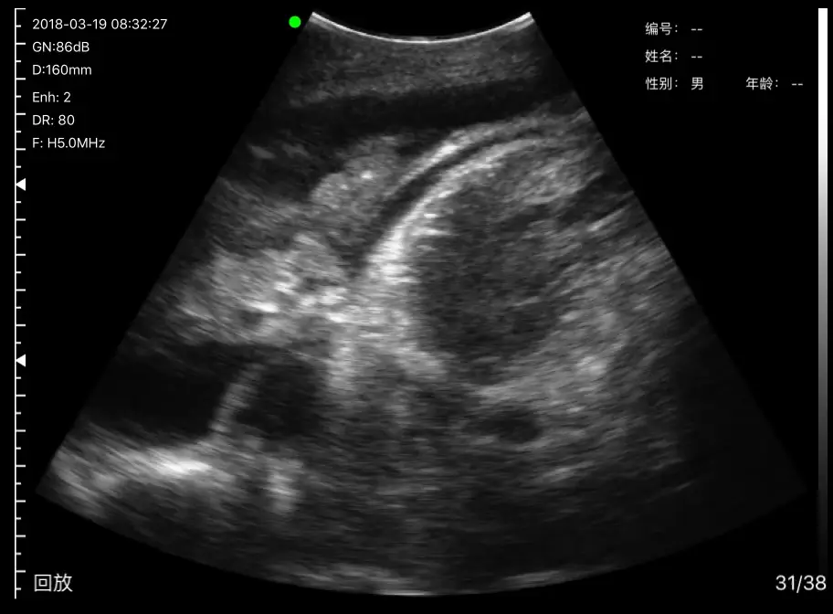Effusion and atelectasis in a cine loop