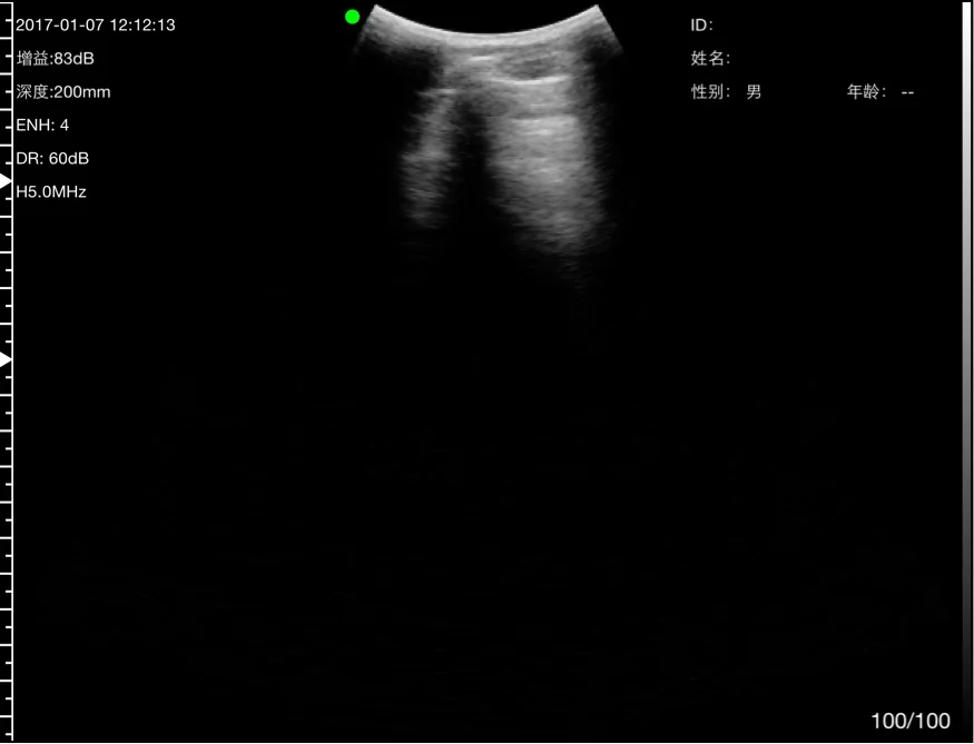 Score the anterior zones, then the posterior bases.