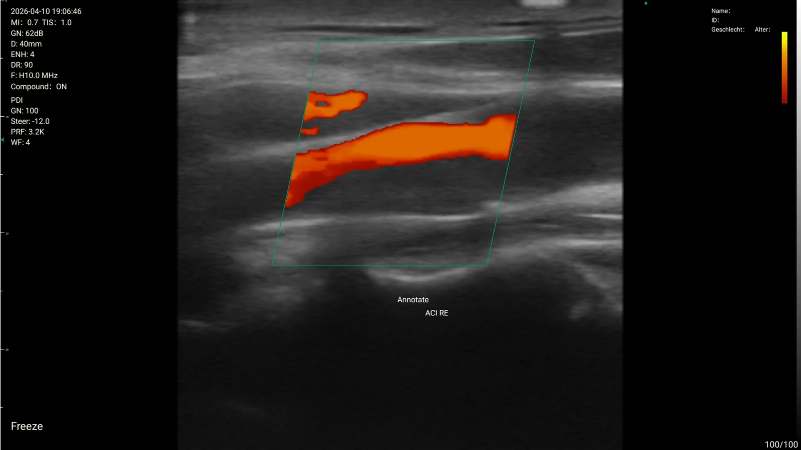 Right internal carotid artery, power Doppler, on the D3Ultra