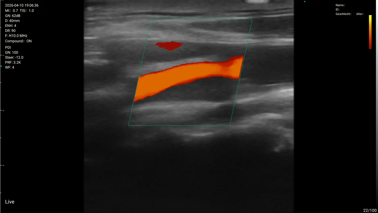 Remote Medicine: remote 10 internal carotid artery power doppler