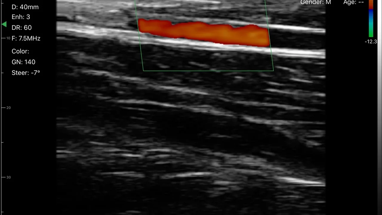 Power Doppler wrist ultrasound on a Suresult handheld
