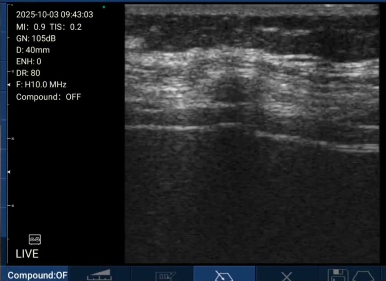 Long-axis rib scan on a Suresult D3Ultra: the bright cortical line runs across the field with layered soft tissue above it as the probe approaches the costochondral junction, 40 mm depth, H10.0 MHz