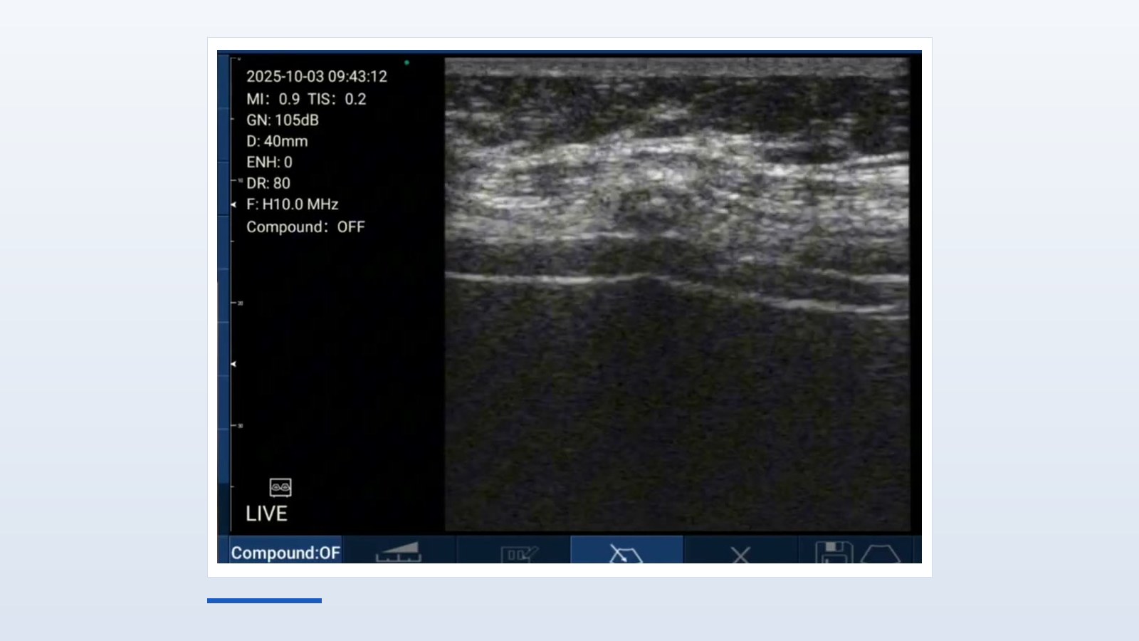 Suresult D3Ultra software window during a rib scan: a continuous bright cortical line running the length of the rib in long axis with clean acoustic shadow beneath, 40 mm depth and H10.0 MHz on the linear head