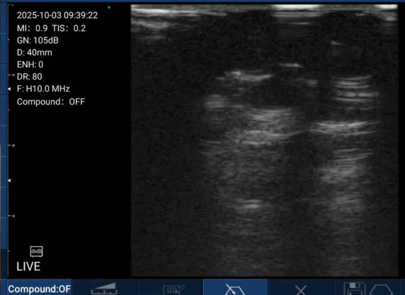 Short-axis rib view on a Suresult D3Ultra: rib cross-sections with posterior acoustic shadowing and the pleural line running between them, 40 mm depth, H10.0 MHz