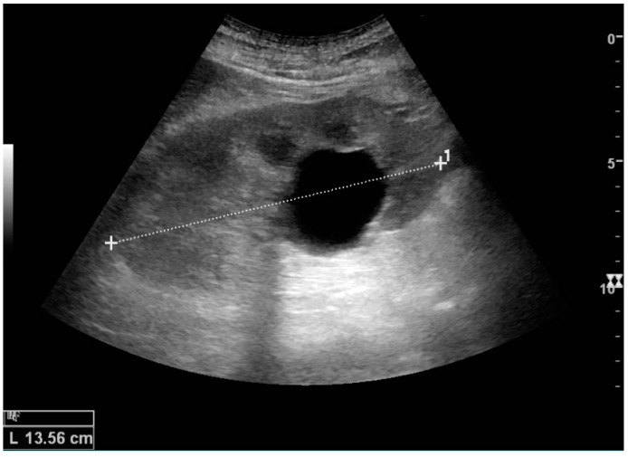 Simple renal cyst ultrasound thumbnail
