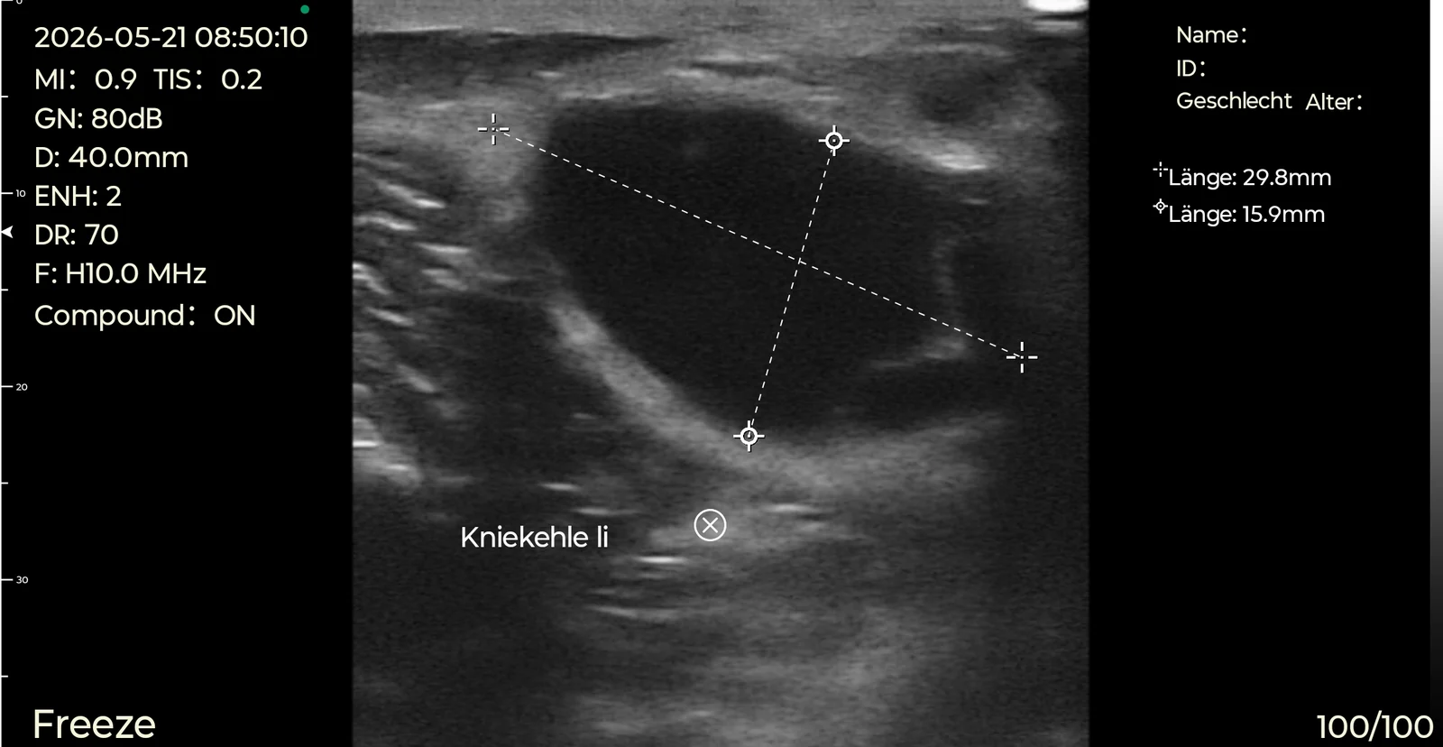 Popliteal cystic structure measured on the D3Ultra