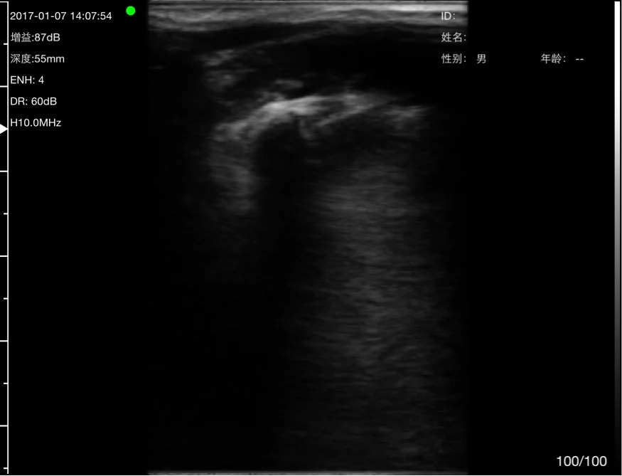 Joint bone surface with an irregular contour