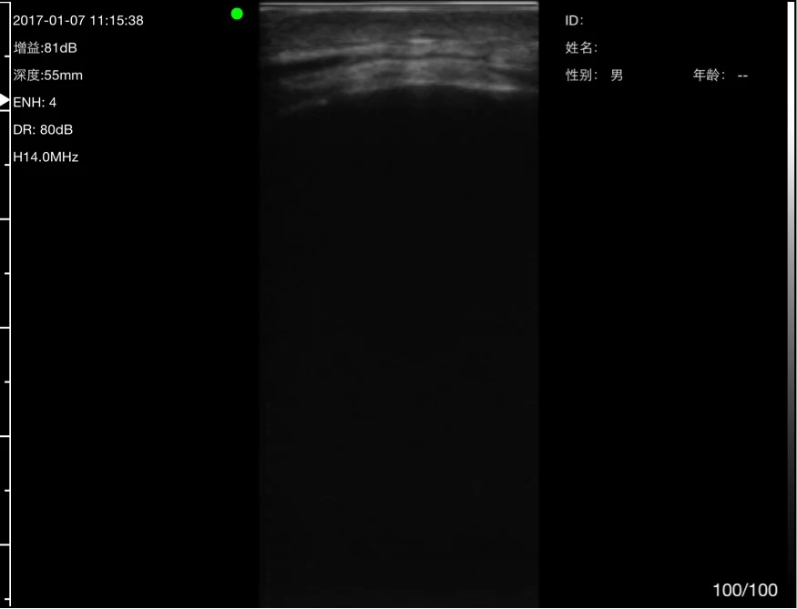 Bone surface with complete acoustic shadowing