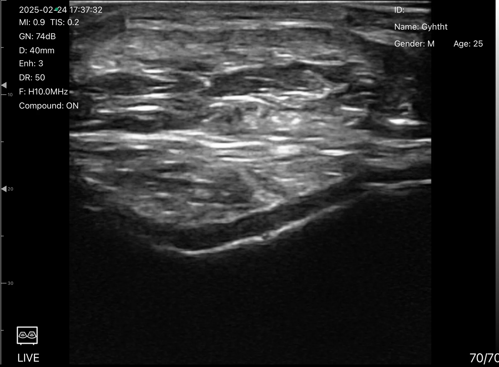 Superficial soft tissue over cortex on the D3Ultra