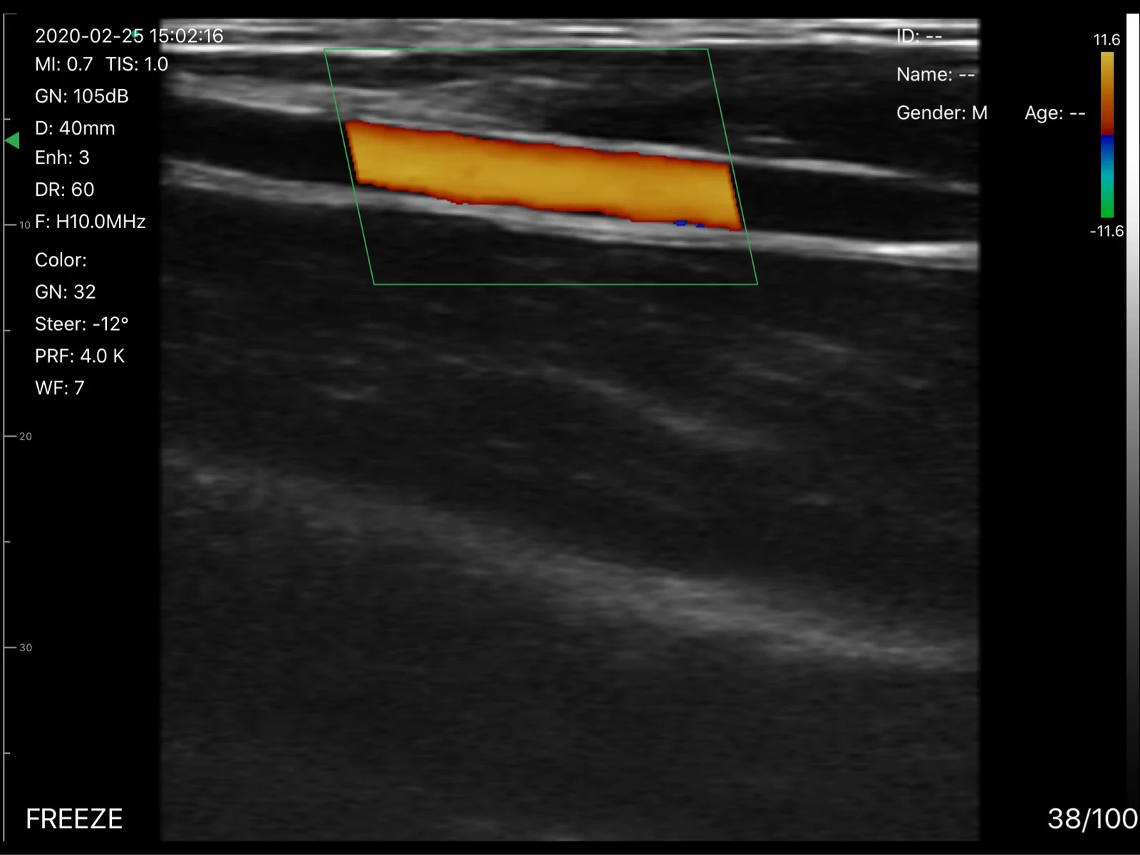 Color Doppler over the wrist on the D3Ultra