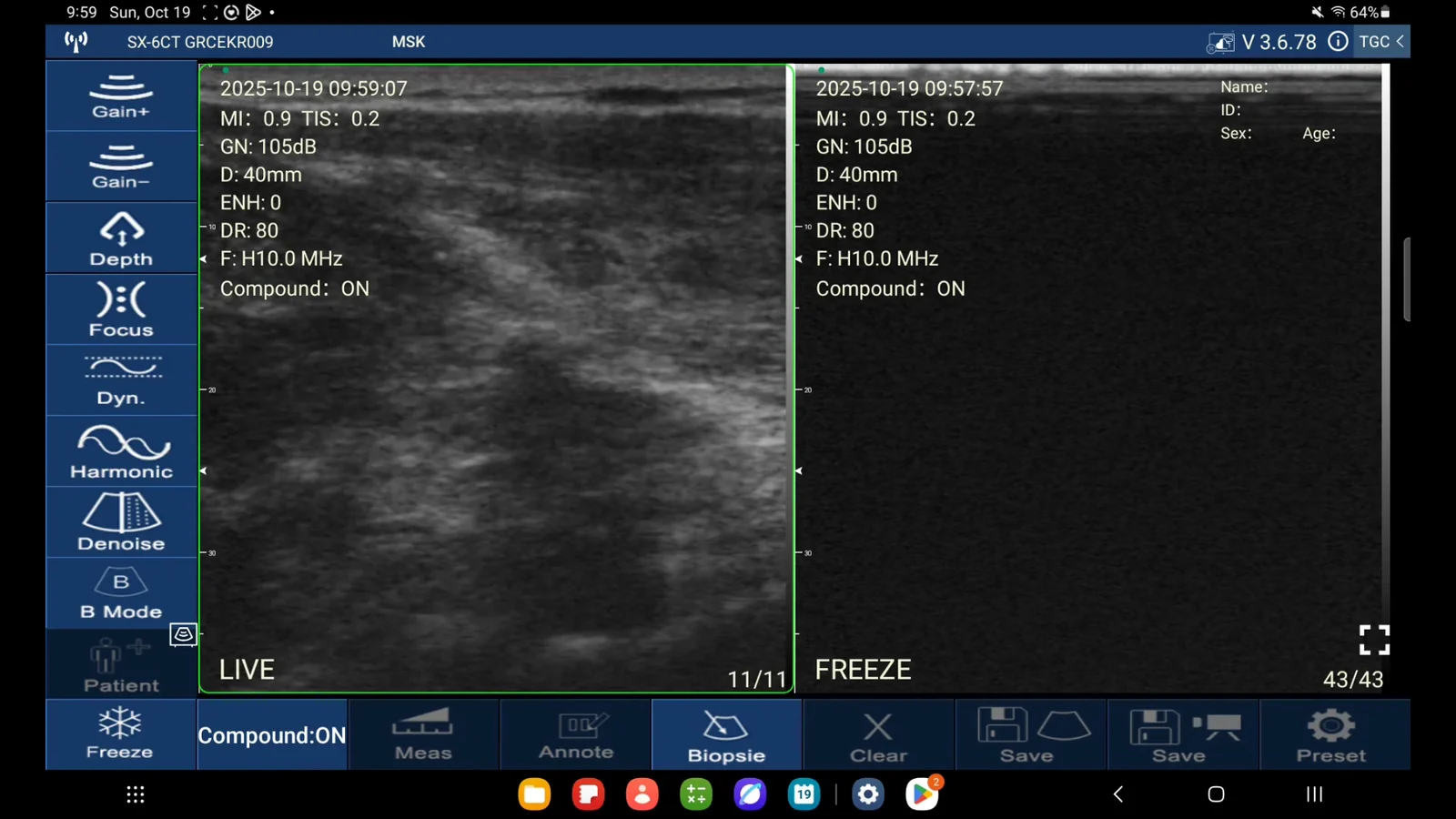 Ulnar collateral ligament tear at the elbow