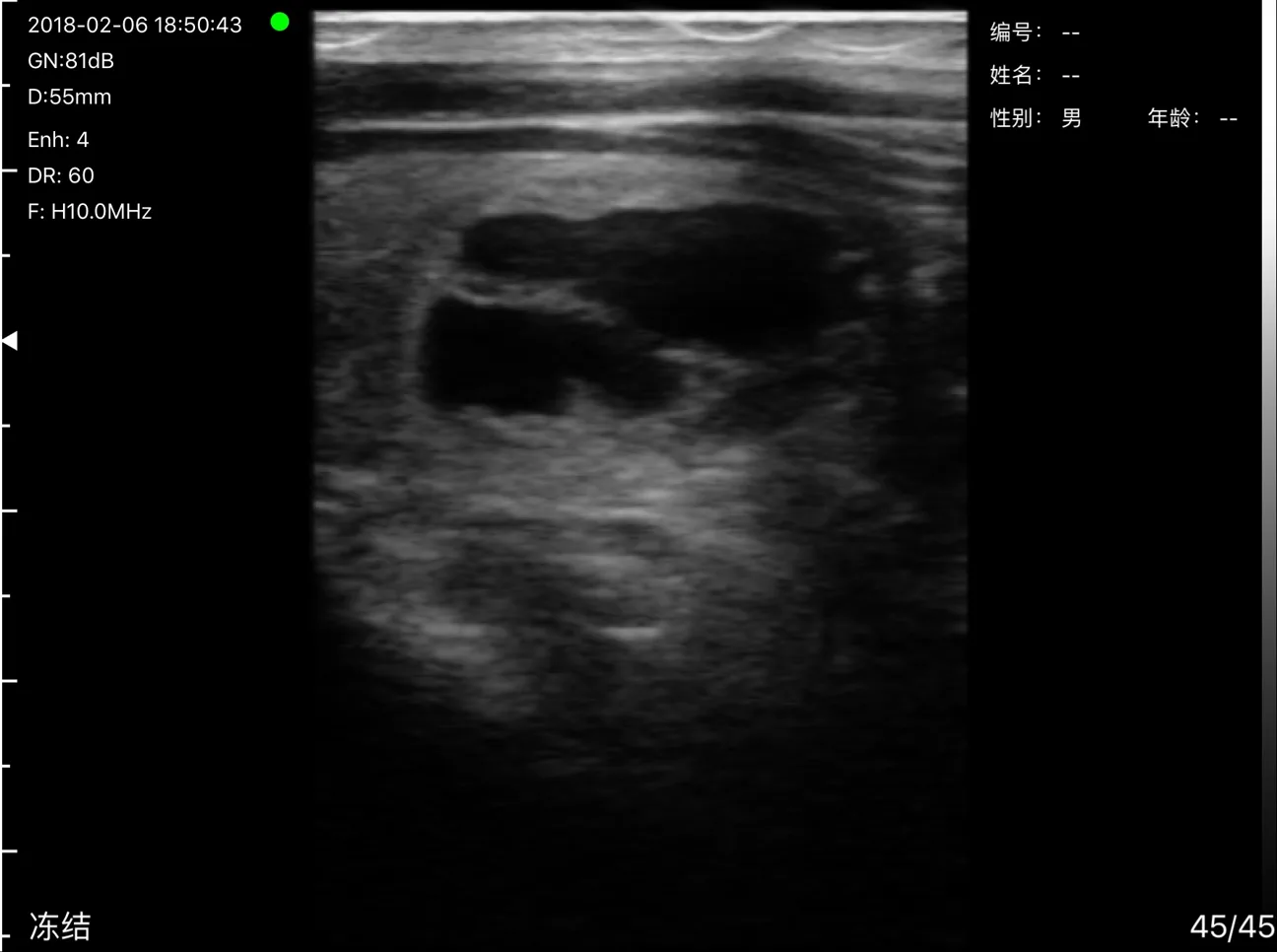 Endocrinology ultrasound key frame