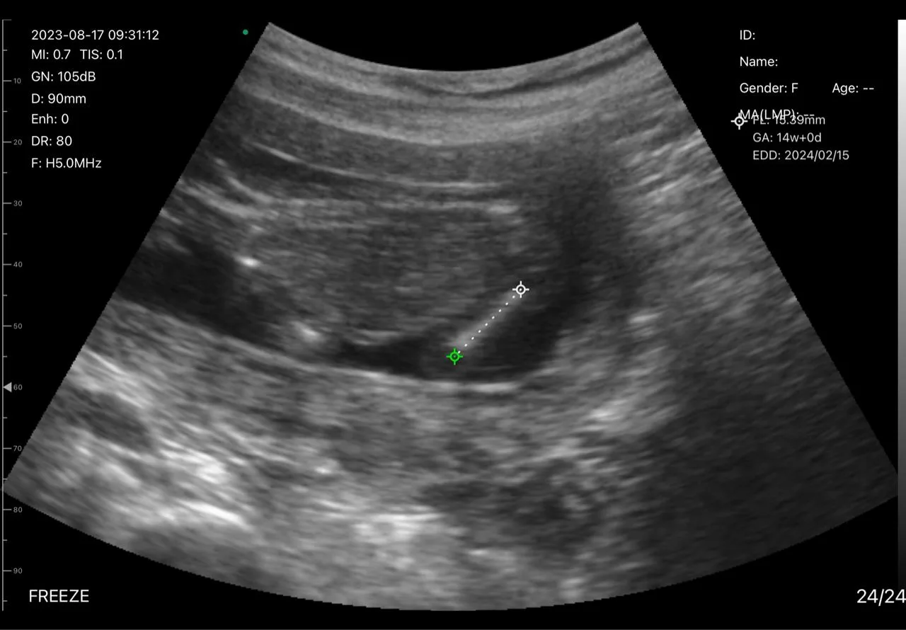 Obstetrics ultrasound key frame
