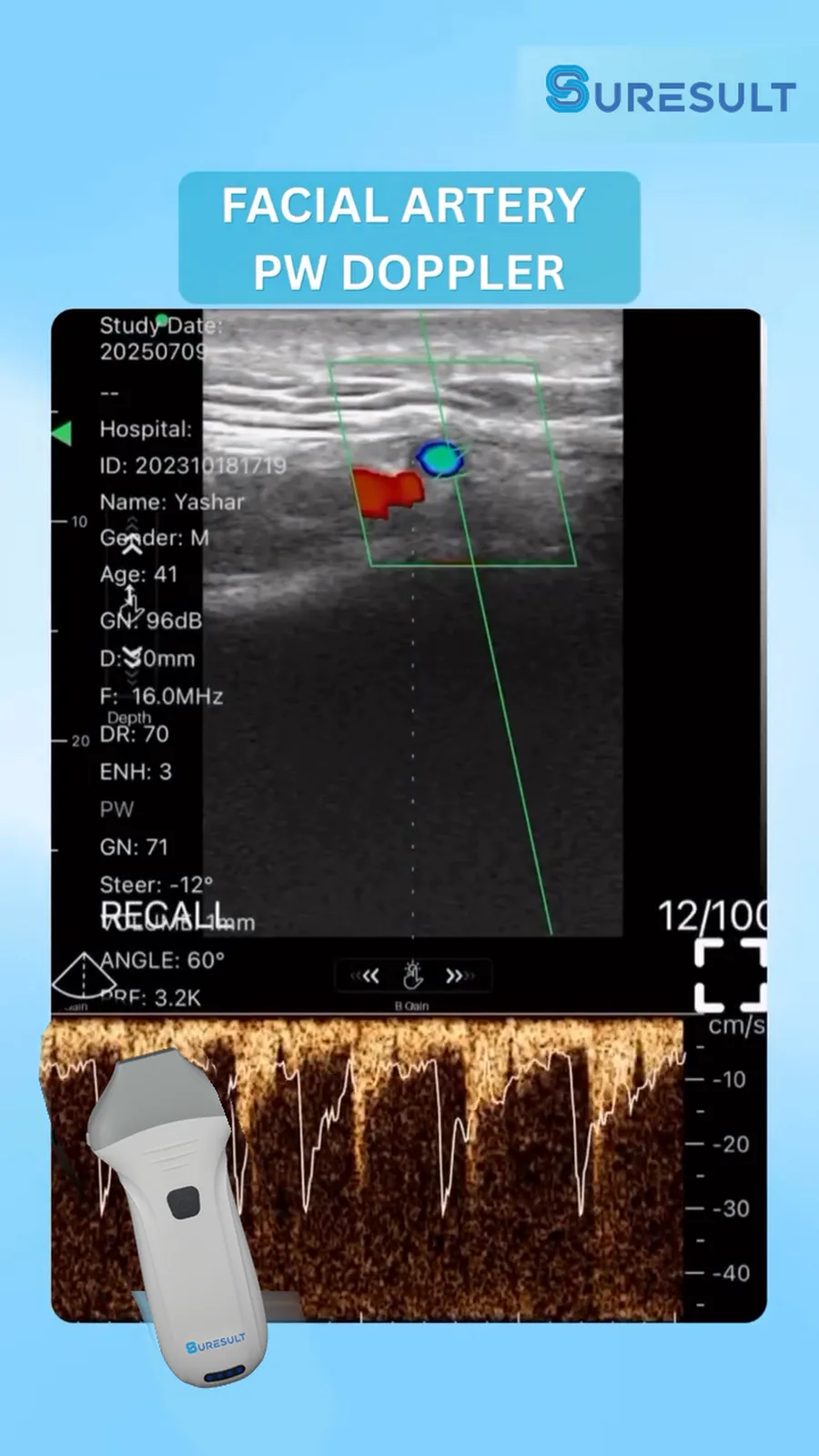 Arteria facialis · PW-doppler · Pro Series scanvoorbeeld